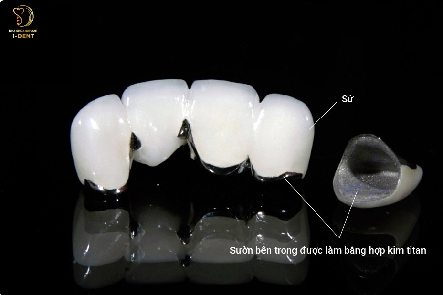 Cấu tạo răng sứ Titan