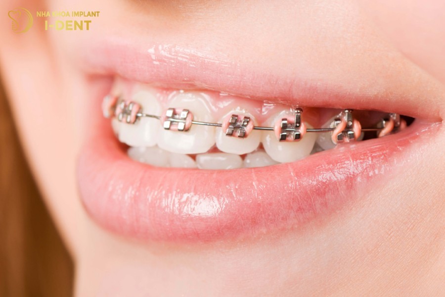 Niềng răng mang lại hàm răng đều đẹp và khớp cắn chuẩn