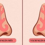 Phẫu Thuật Vách Ngăn Mũi Là Gì