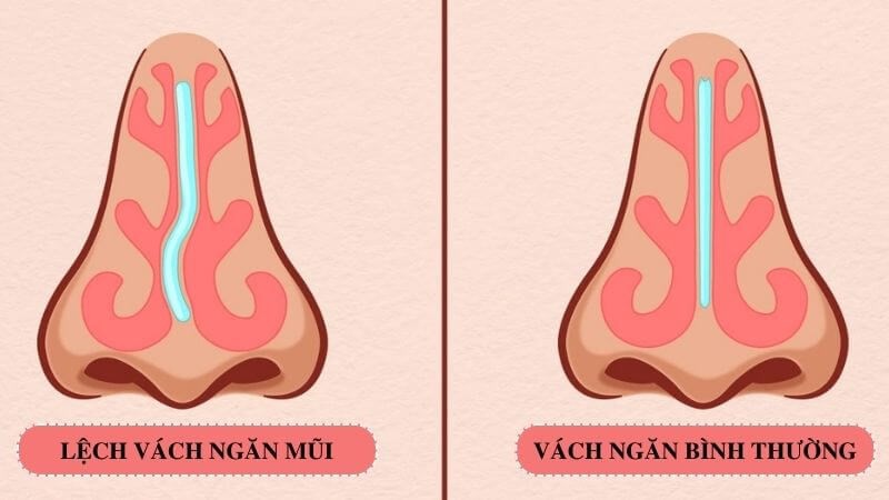 Phẫu Thuật Vách Ngăn Mũi Là Gì
