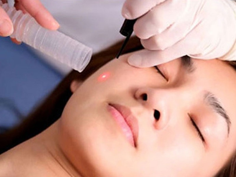 Xóa nốt ruồi bằng laser an toàn hiệu quả