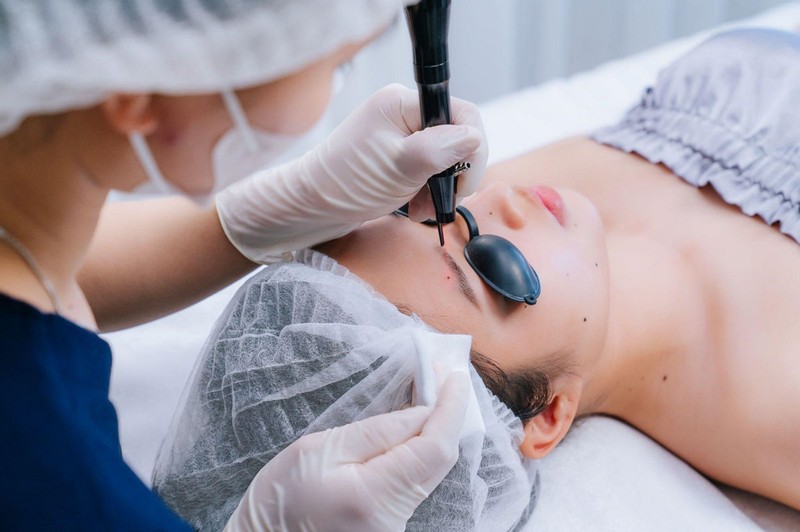 Xóa nốt ruồi bằng laser ít để lại sẹo