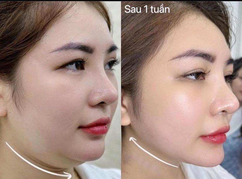 Cằm thon gọn sau khi tiêm tan mỡ nọng cằm 1 tuần