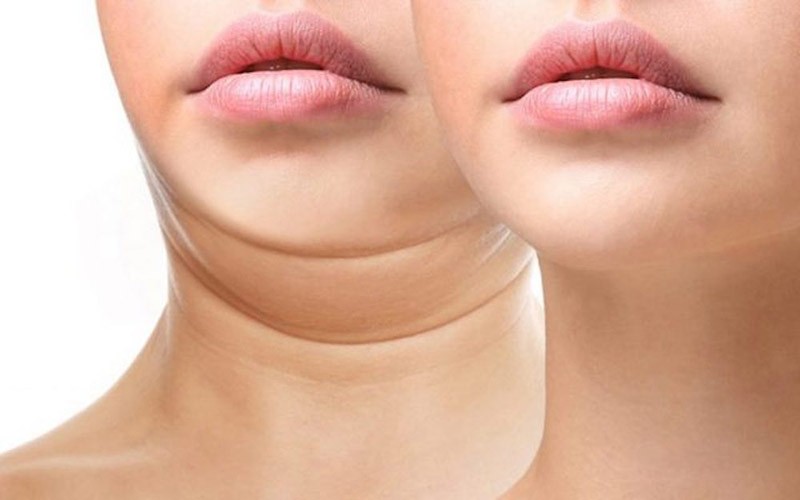 Tiêm tan mỡ nọng cằm có giá tùy vào lượng mỡ, cơ sở thực hiện