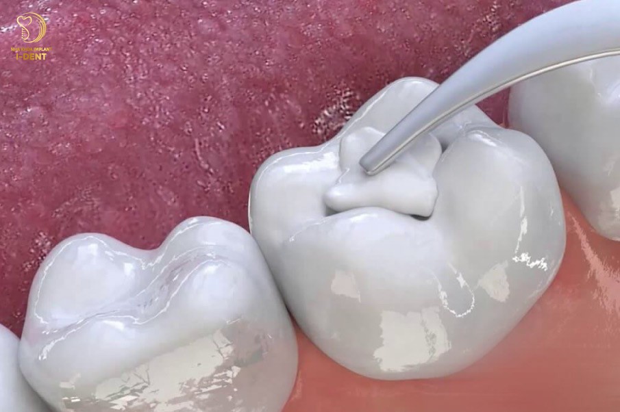 Các trường hợp cần trám răng thẩm mỹ, bao gồm răng sâu, răng mẻ, răng thưa và răng bị nhiễm màu