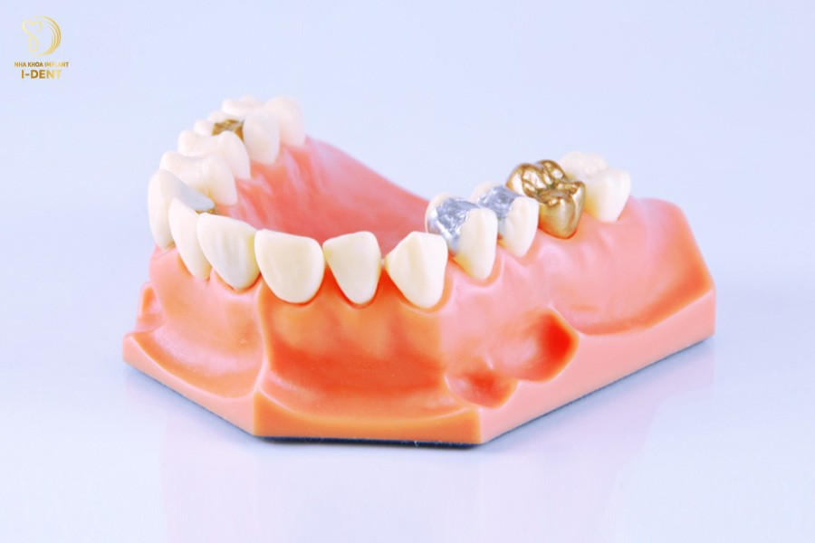 Quy trình trám răng thẩm mỹ tại Xe Tải Mỹ Đình, từ thăm khám, gây tê, loại bỏ răng sâu đến trám răng và đánh bóng
