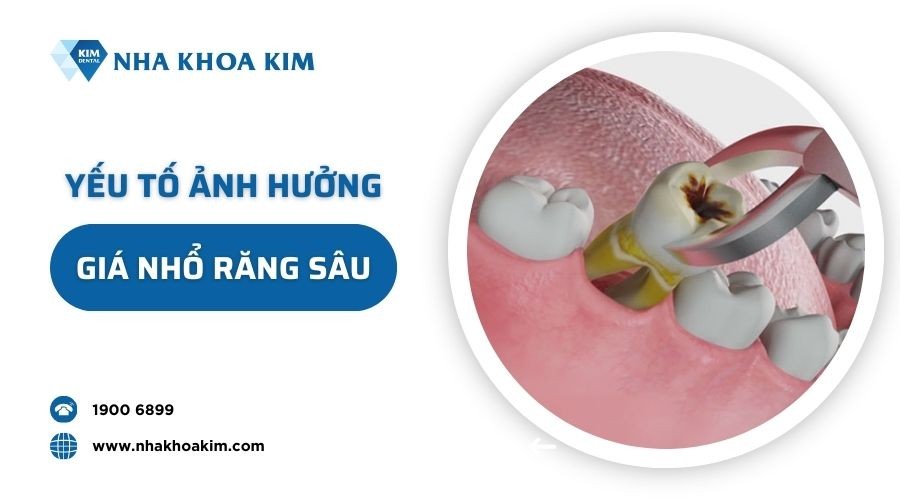 Nhổ răng giá bao nhiêu?